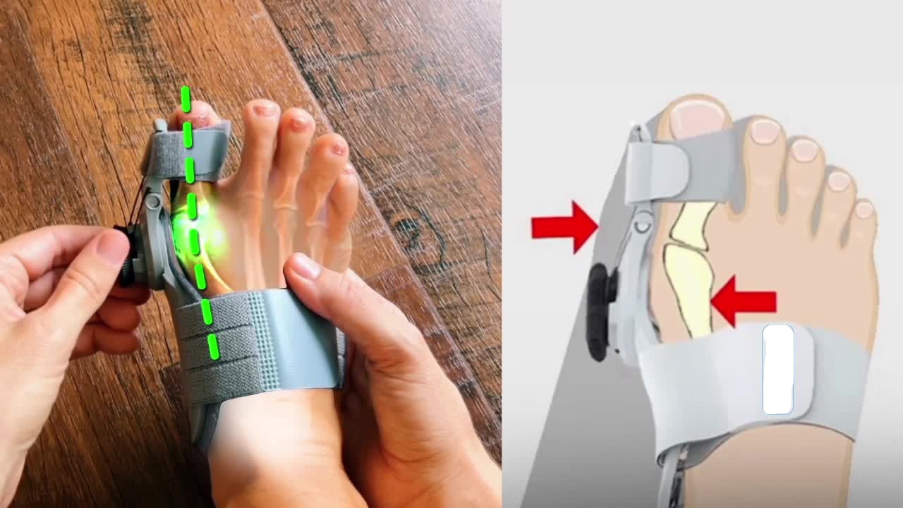 Ayak başparmağı düzeltici